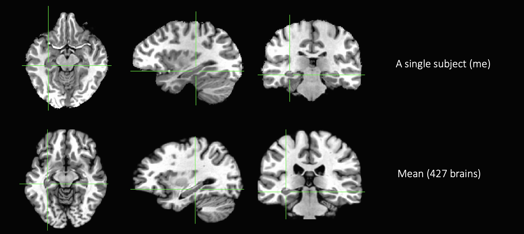 Voxel based morphometry