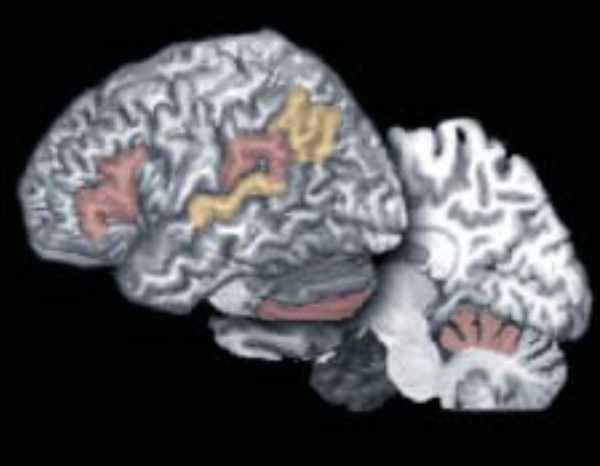 Structural Imaging in Reading Dyslexia
